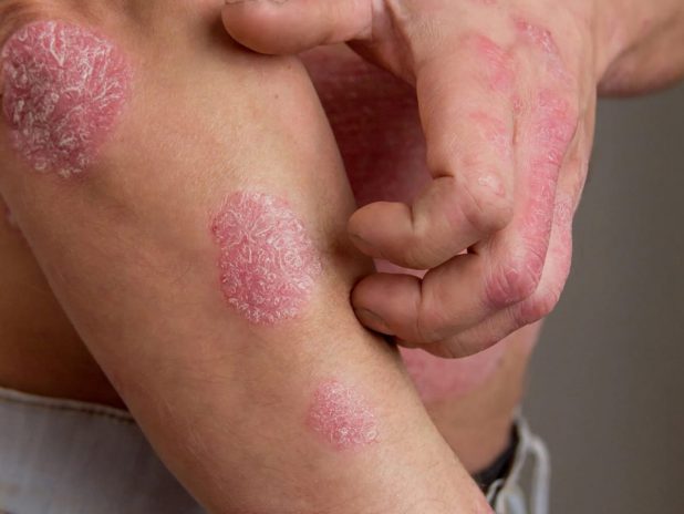 paciente de psoríase se coçando no antebraço direito